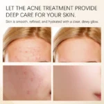 Acne Cream Treatment Spu863616191893 3
