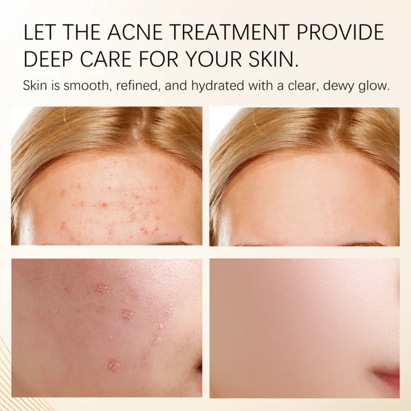 Acne Cream Treatment Spu863616191893 3