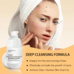 Acne Cream Treatment Spu863616191893 4