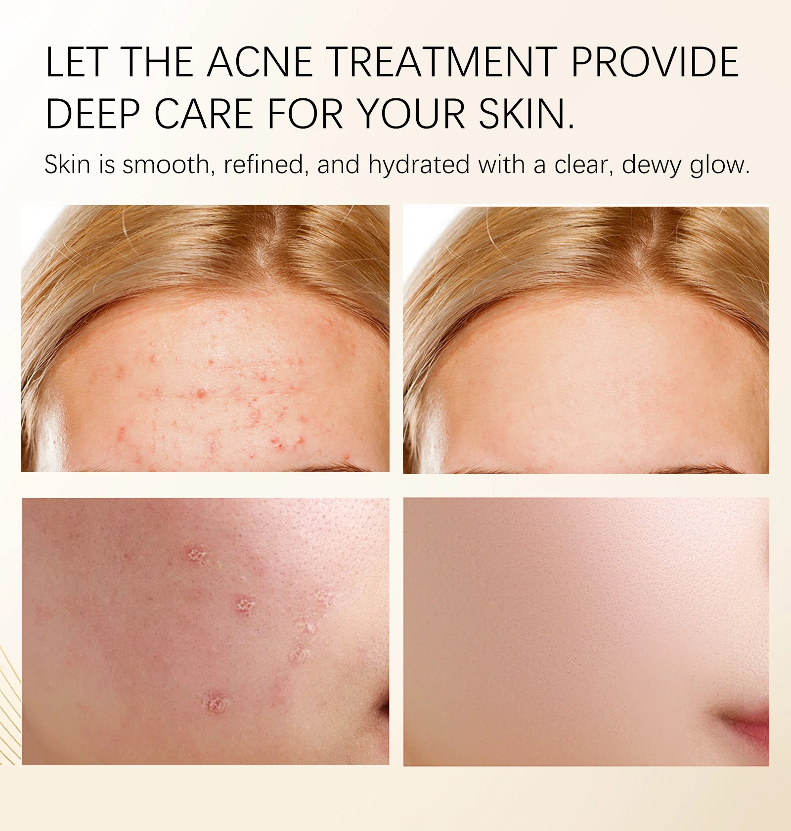 acne cream treatment spu863616191893 desc 9