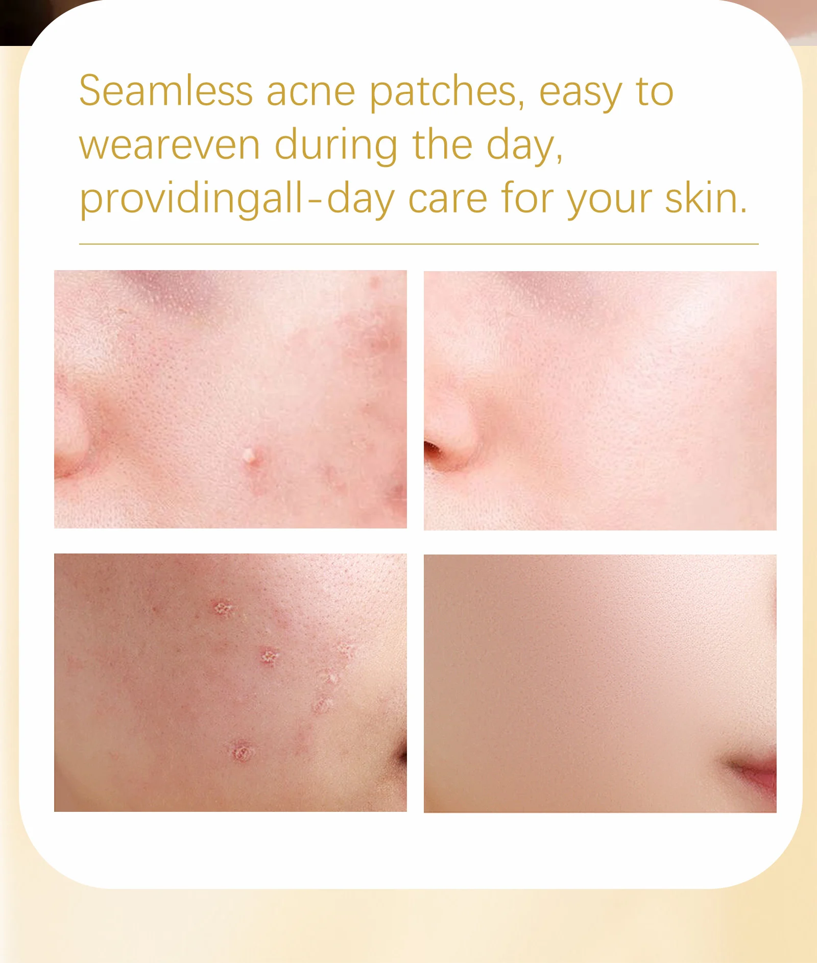 acne patches spu919760083313 desc 10