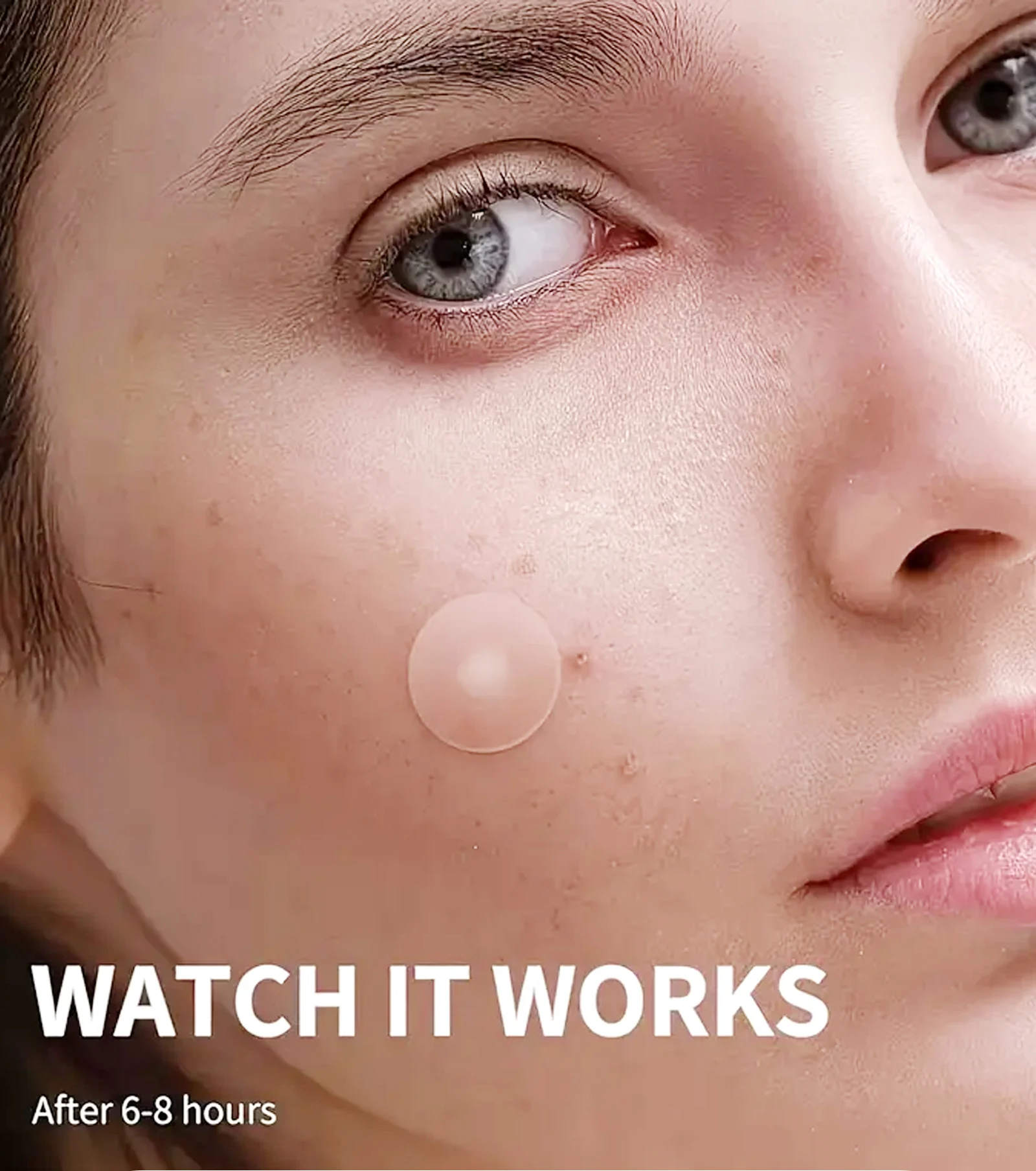 acne patches spu919760083313 desc 9