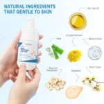 Acne Treatment Gel Spu747761117888 4