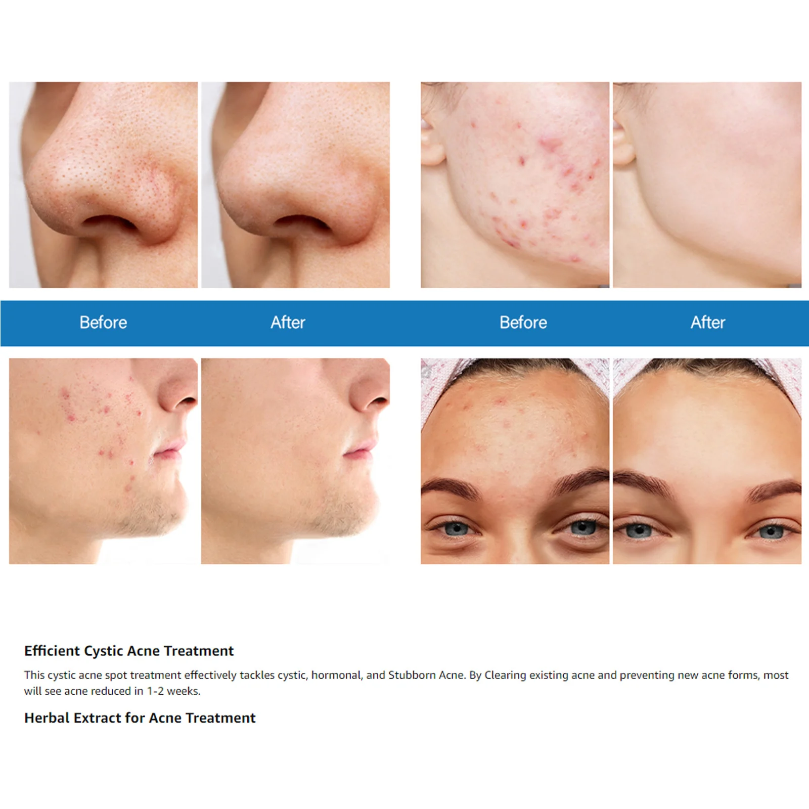 YURHERSU Acne Treatment Gel with Aloe and Tea Tree Oil for Face and Body 2 acne treatment gel spu747761117888 desc 2