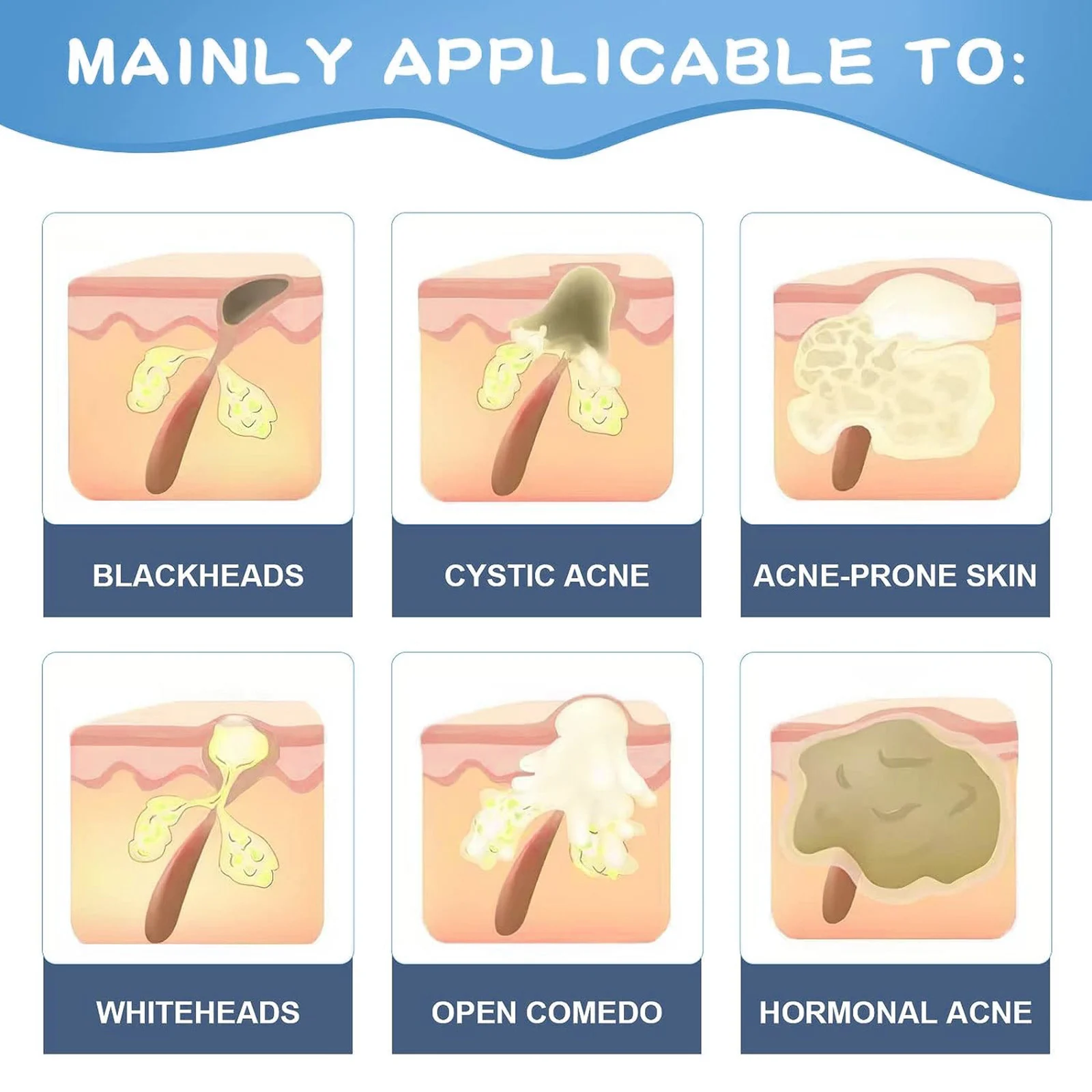 YURHERSU Acne Treatment Gel with Aloe and Tea Tree Oil for Face and Body 6 acne treatment gel spu747761117888 desc 6