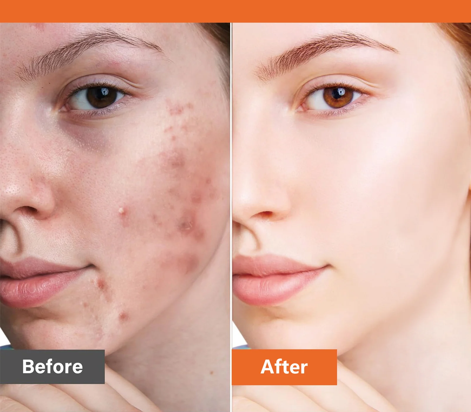 azelaic acid acne treatment cream spu789839093665 desc 4