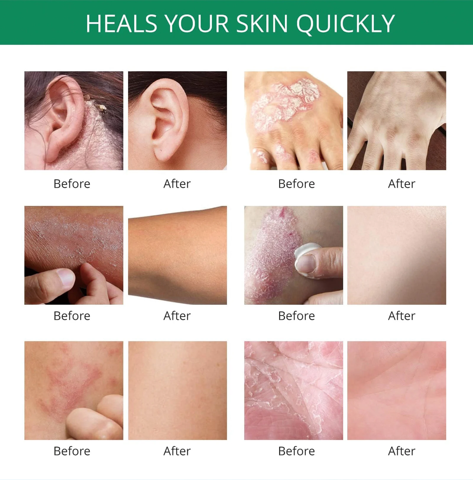 psoriasis cream itch relief spu760493845062 desc 4