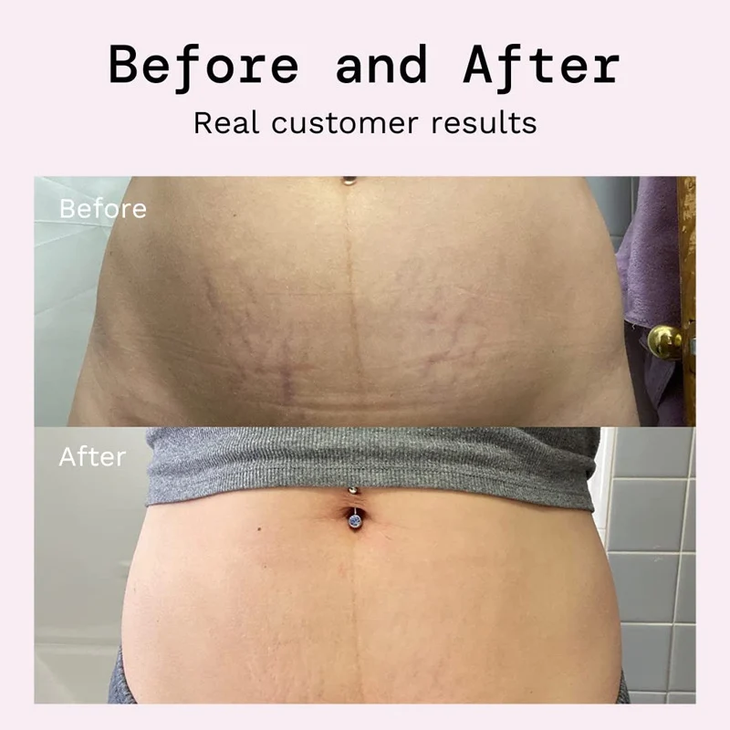 stretch mark cream repair spu963808575592 desc 5